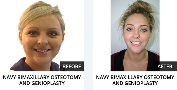 Navy Bimaxillary Osteotomy and Genioplasty Before After
