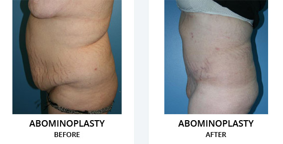 Abominoplasty Before After