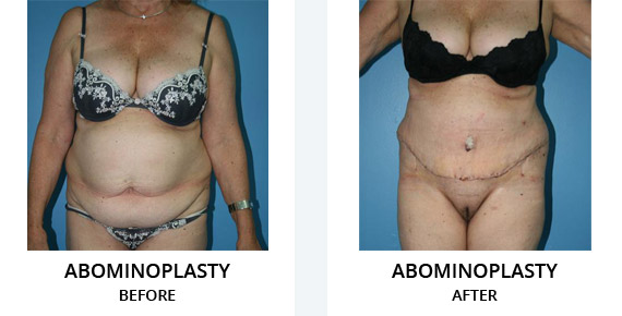Abominoplasty Before After