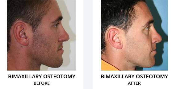 Bimaxillary osteotomy Before After