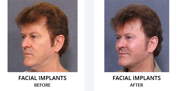 Facial implants Before After