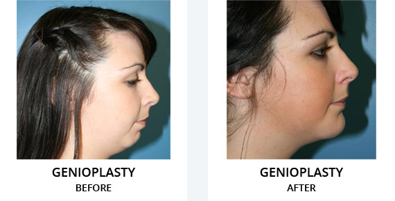 Genioplasty Before After