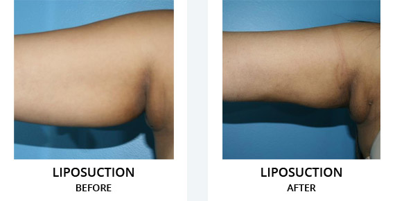 Liposuction Before After