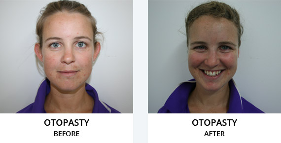 Otopasty Before After