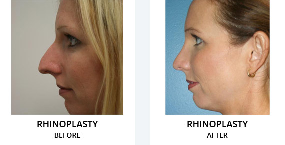 rhinoplasty Image
