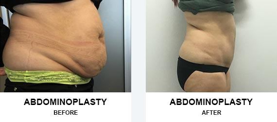 abdominoplasty Before After