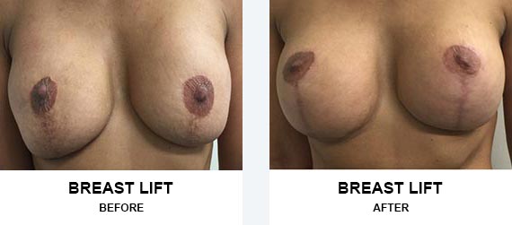 Breast Lift Before After