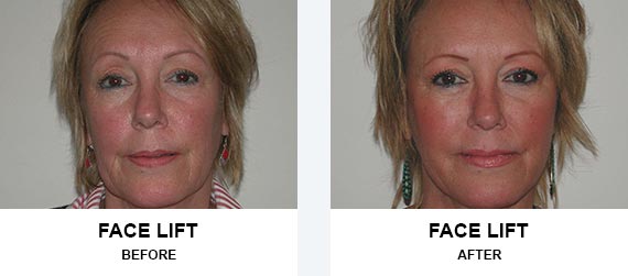 Face lift Before After