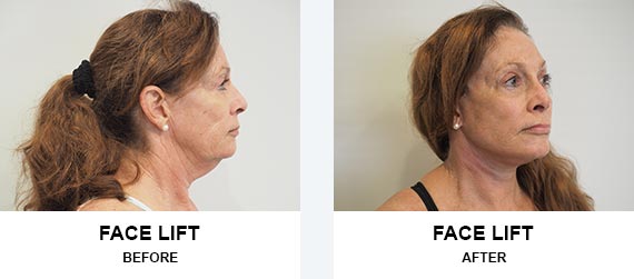 Face lift Before After
