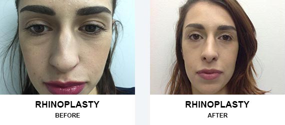 Rhinoplasty Before After