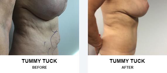 abdominoplasty Before After