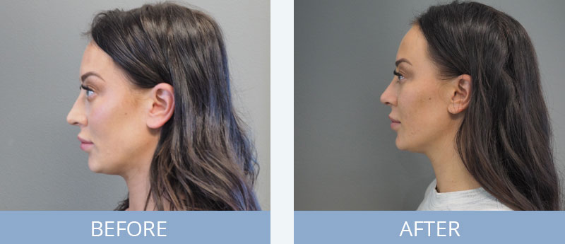 Side View Of Nose Job Surgery Patient
