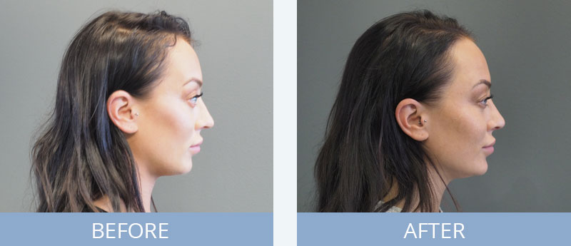 Refine Clinic Sydney Rhinoplasty Before and After