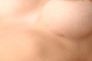 breast implant scars image bondi junction