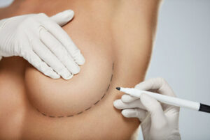 breast implant scars procedure bondi junction